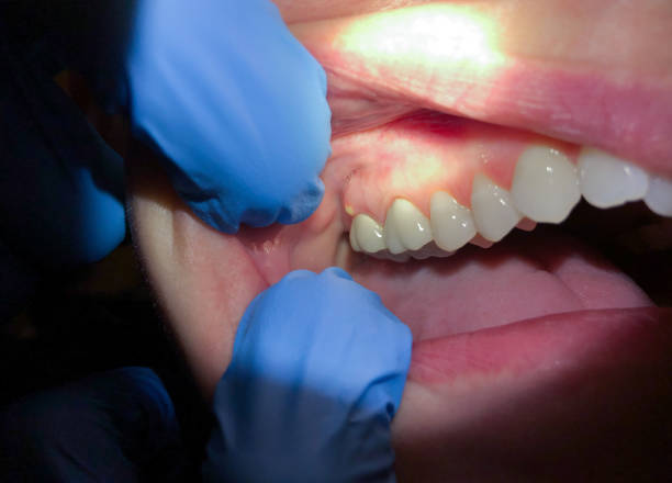 Best Broken or Chipped Tooth Repair in Elkhart, KS